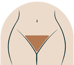 Basic bikini wax illustration: hair left in a triangle at the front