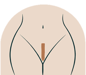 Brazilian wax illustration: a narrow strip of hair left at the front